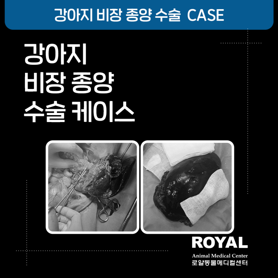 비장종양 수술 케이스